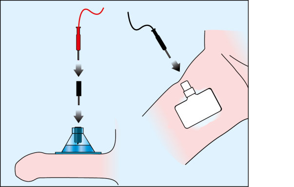 Introduce the adapter into the opening and then secure the cables of the electric generator (red to the CT-DAS and black to the dispersive)