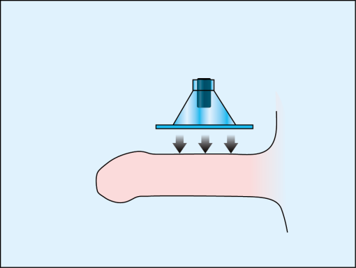 Remove the protective film from the adhesive part of electrode CT-DAS and place the electrode on the plaque to completely adhere to the skin