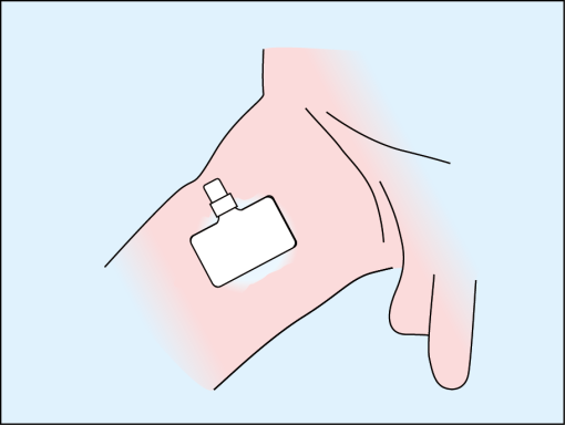 Step 3: Impregnate the dispersive electrode with tap water or physiological saline and place it on the gel. Move it from one side to the oth