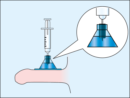 Fill the CT-DAS electrode by injecting the drug solution (5 ml) into it with a syringe with a rounded tip needle. 